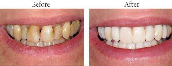 Mint Hill Before and After Teeth Whitening, Matthews Before and After  Dental Implants
