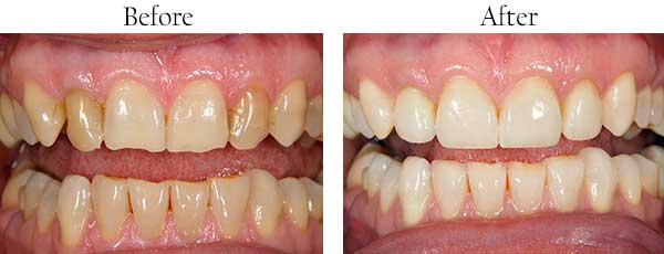 Mint Hill Before and After Teeth Whitening